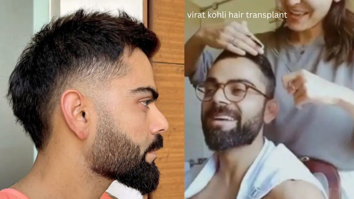 virat kohli hair transplant