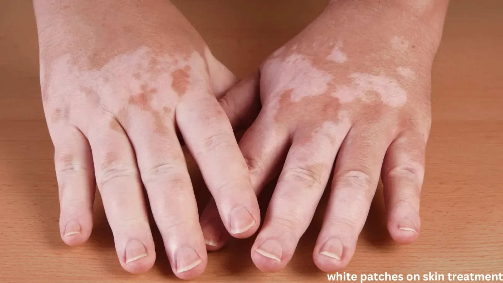 white patches on skin treatment