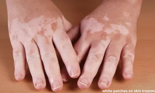 White Patches on Skin Treatment: Causes, Remedies, and Solutions