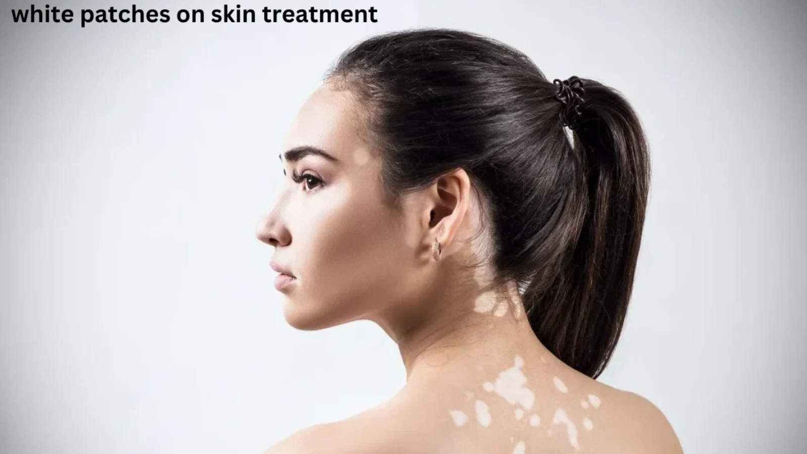 white patches on skin treatment