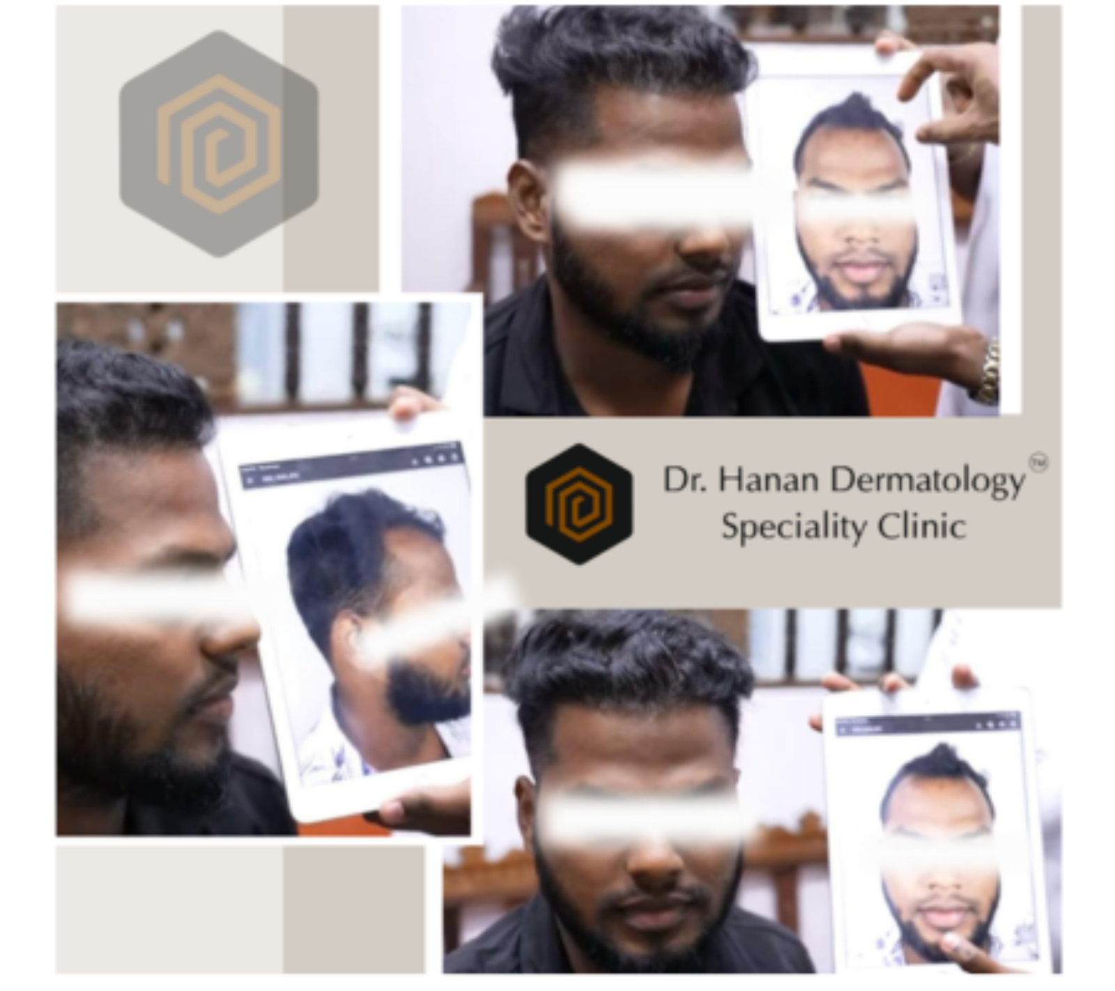 Hair Transplant in OMR – Expert Hair Restoration at Dr. Hanan Dermatology Speciality Clinic