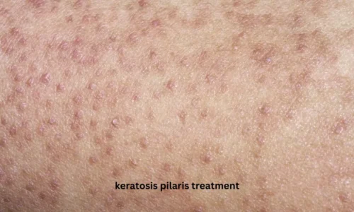 Keratosis Pilaris Treatment: Best Ways to Get Smooth, Bump-Free Skin