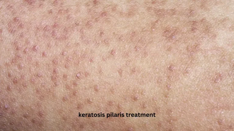 Keratosis Pilaris Treatment: Best Ways to Get Smooth, Bump-Free Skin
