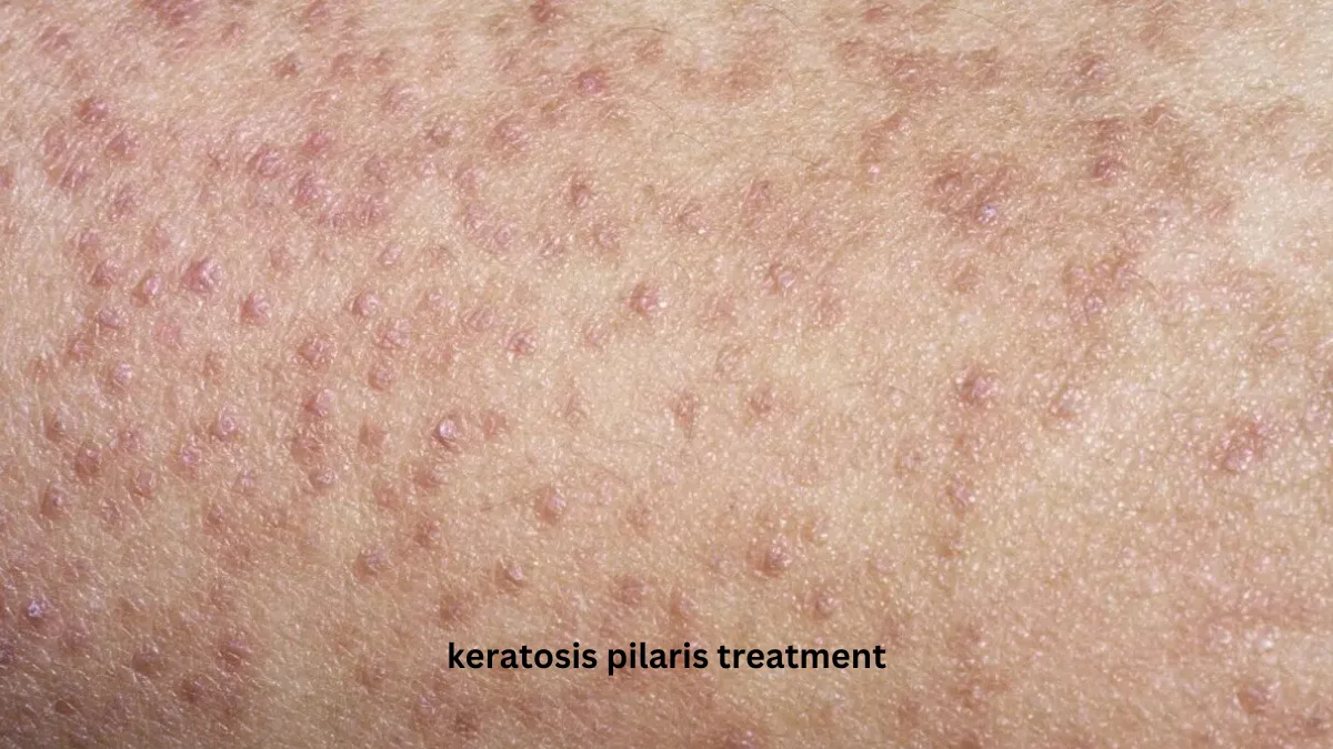 keratosis pilaris treatment