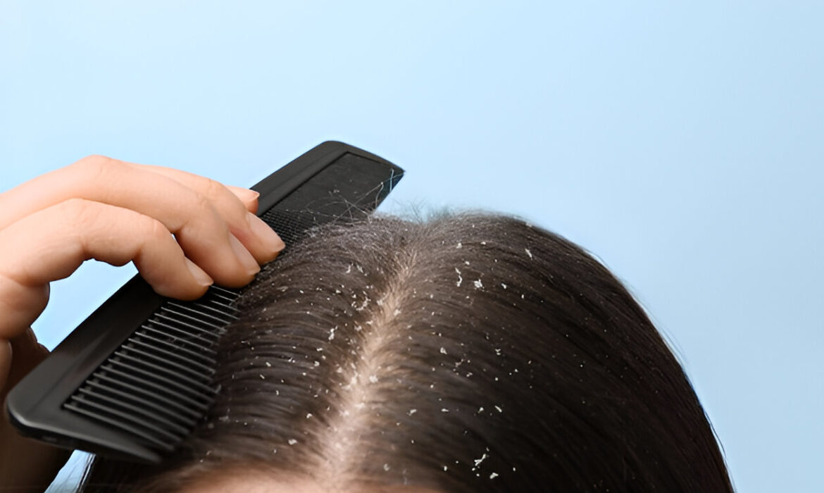 How to get rid of dandruff