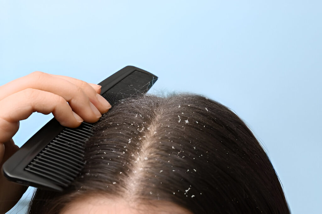 How to get rid of dandruff