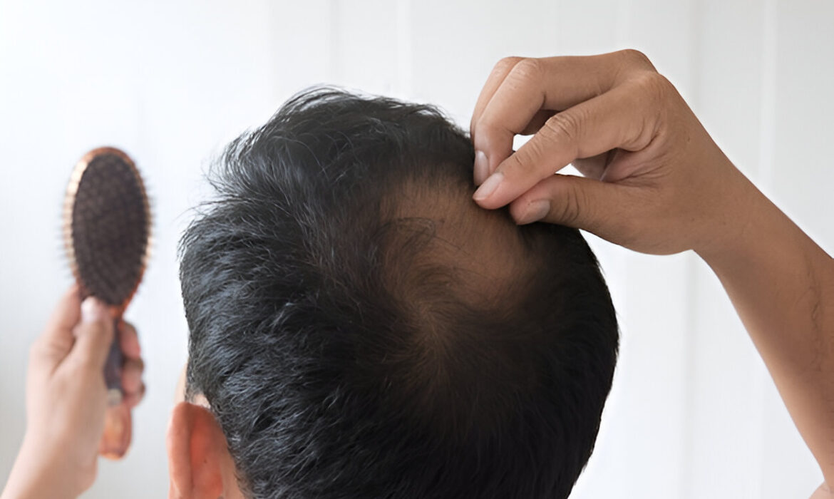 Ideal age for hair Transplant