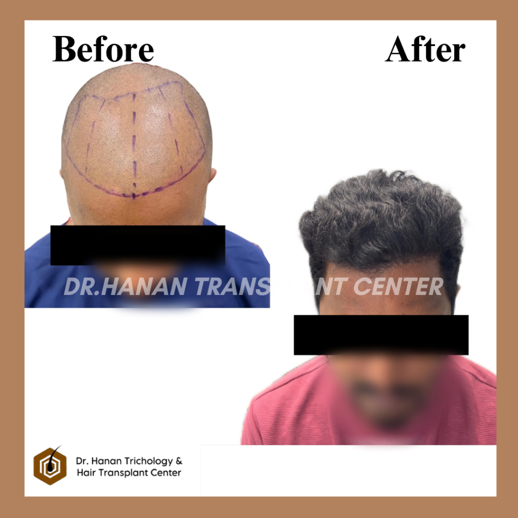 Stem Cell Hair Treatment Before and After Stem Cell Hair Treatment Before and After