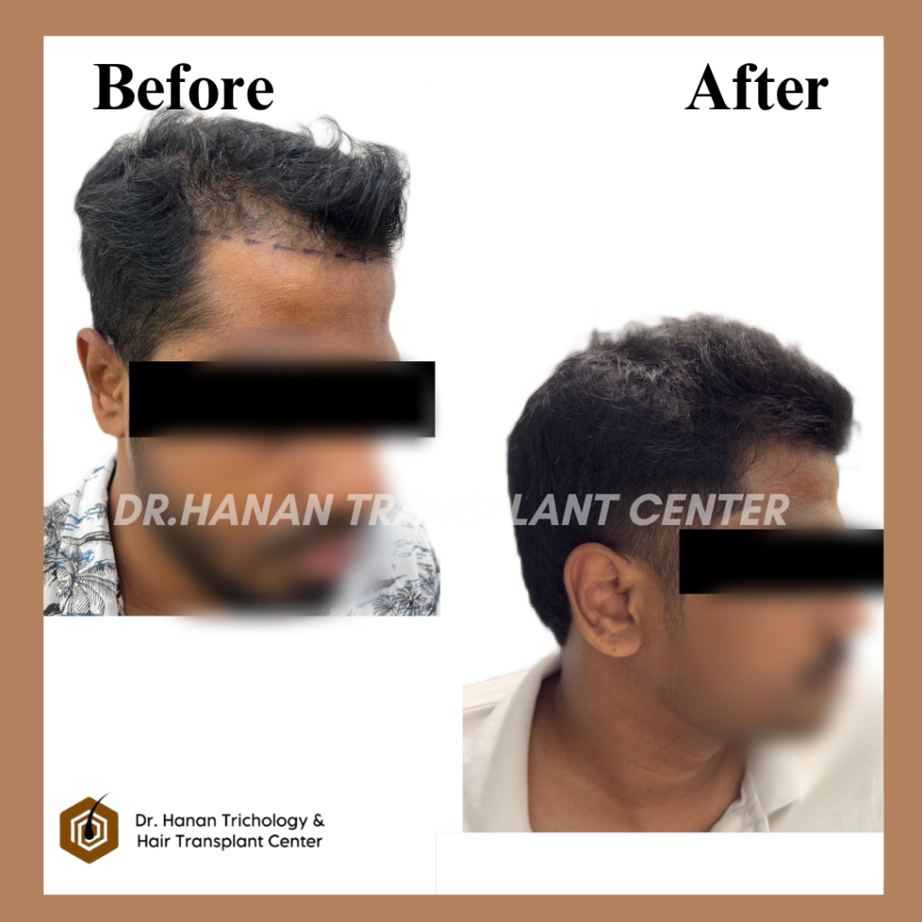 New Roots Hair Transplant Cost in Chennai