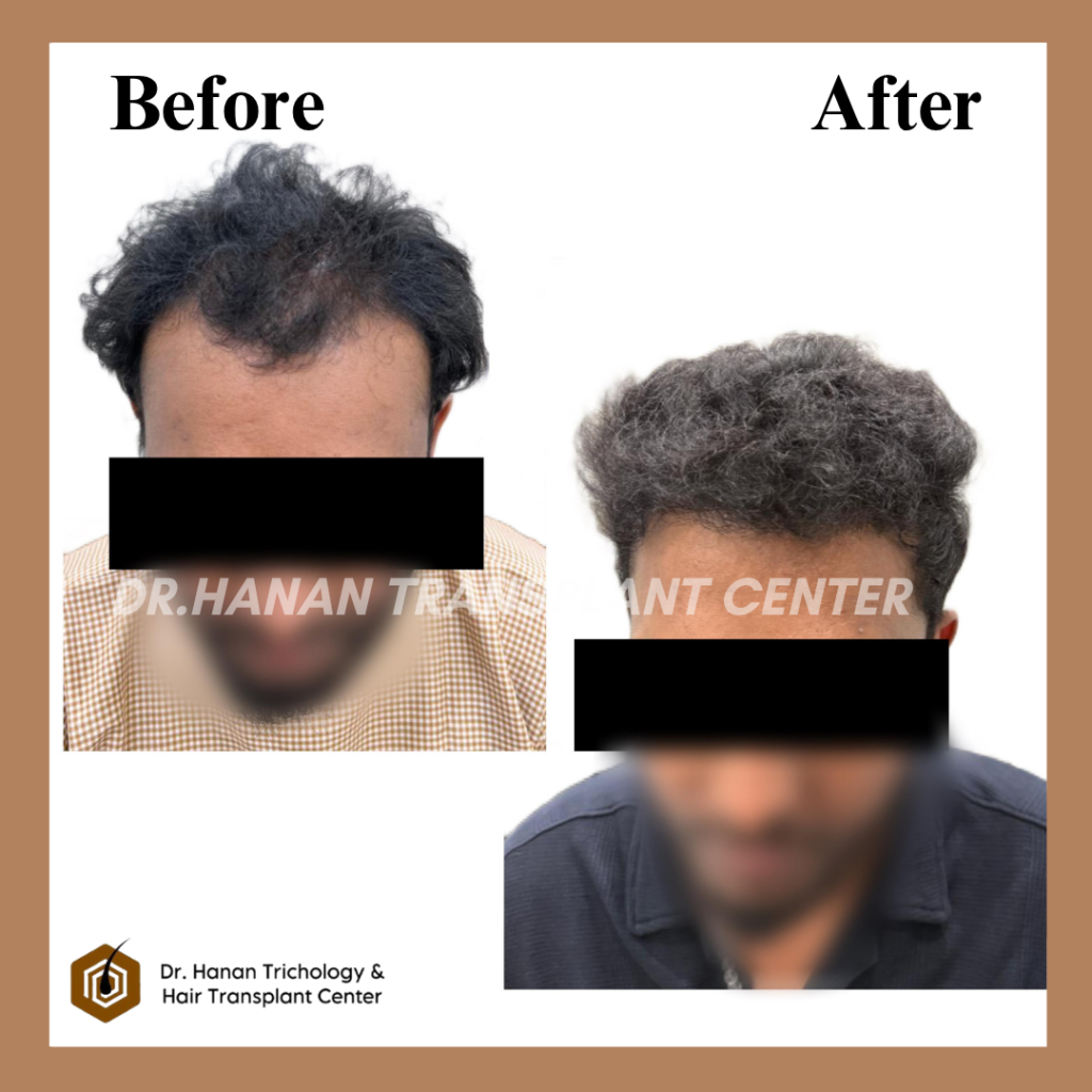 Latest Hair Transplant Technology in India Latest Hair Transplant Technology in India