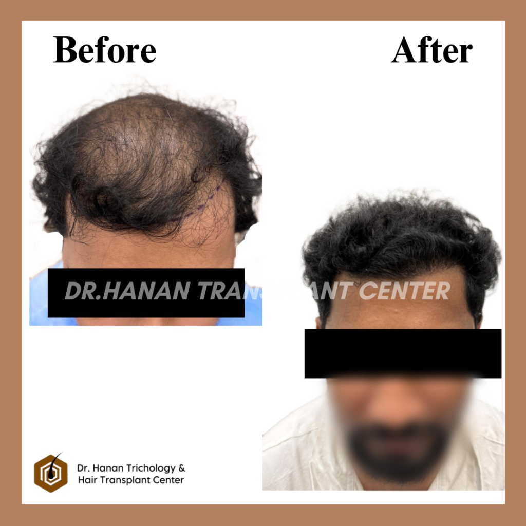 Latest Hair Transplant Technology in India Price
