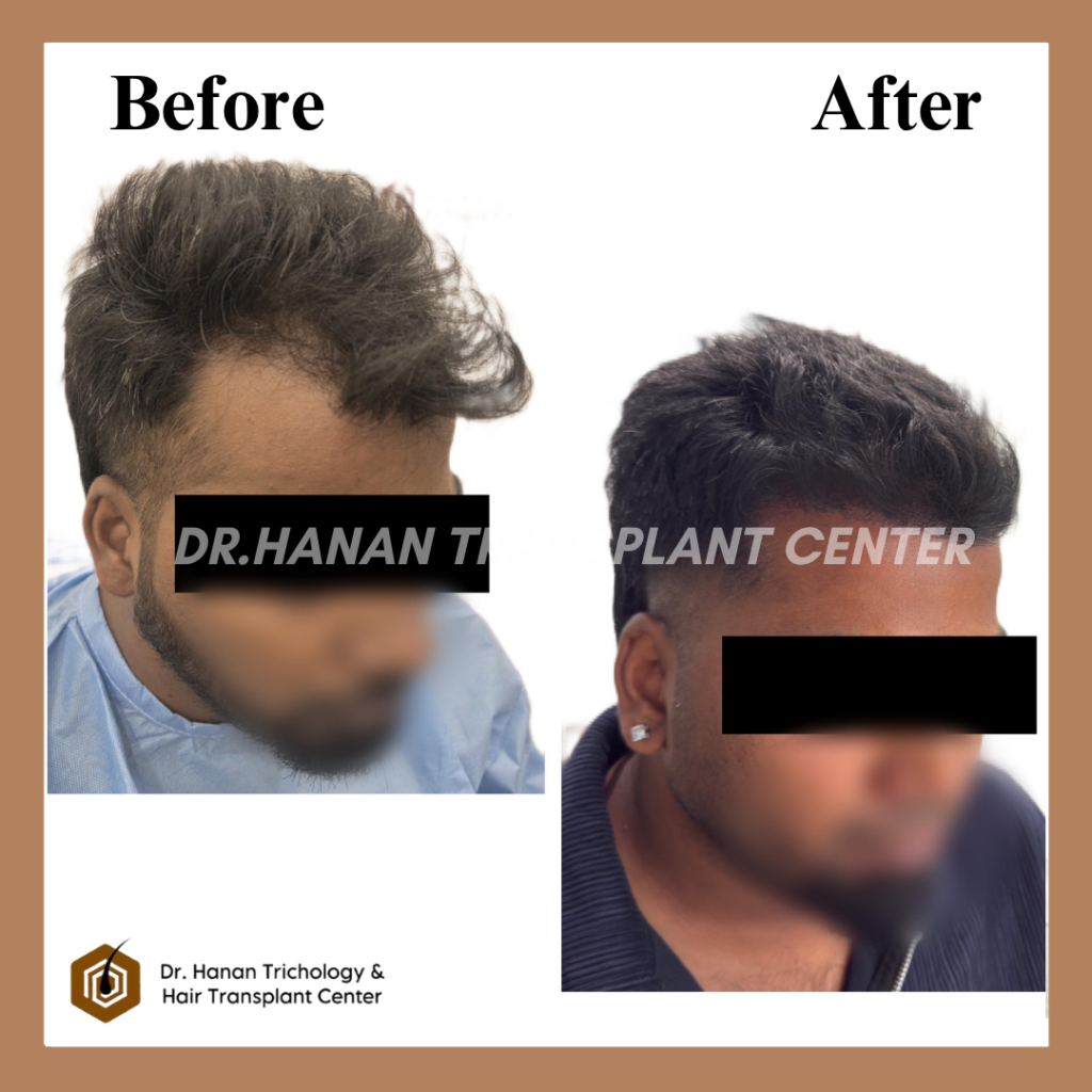 hair transplant in OMR hair transplant in OMR
