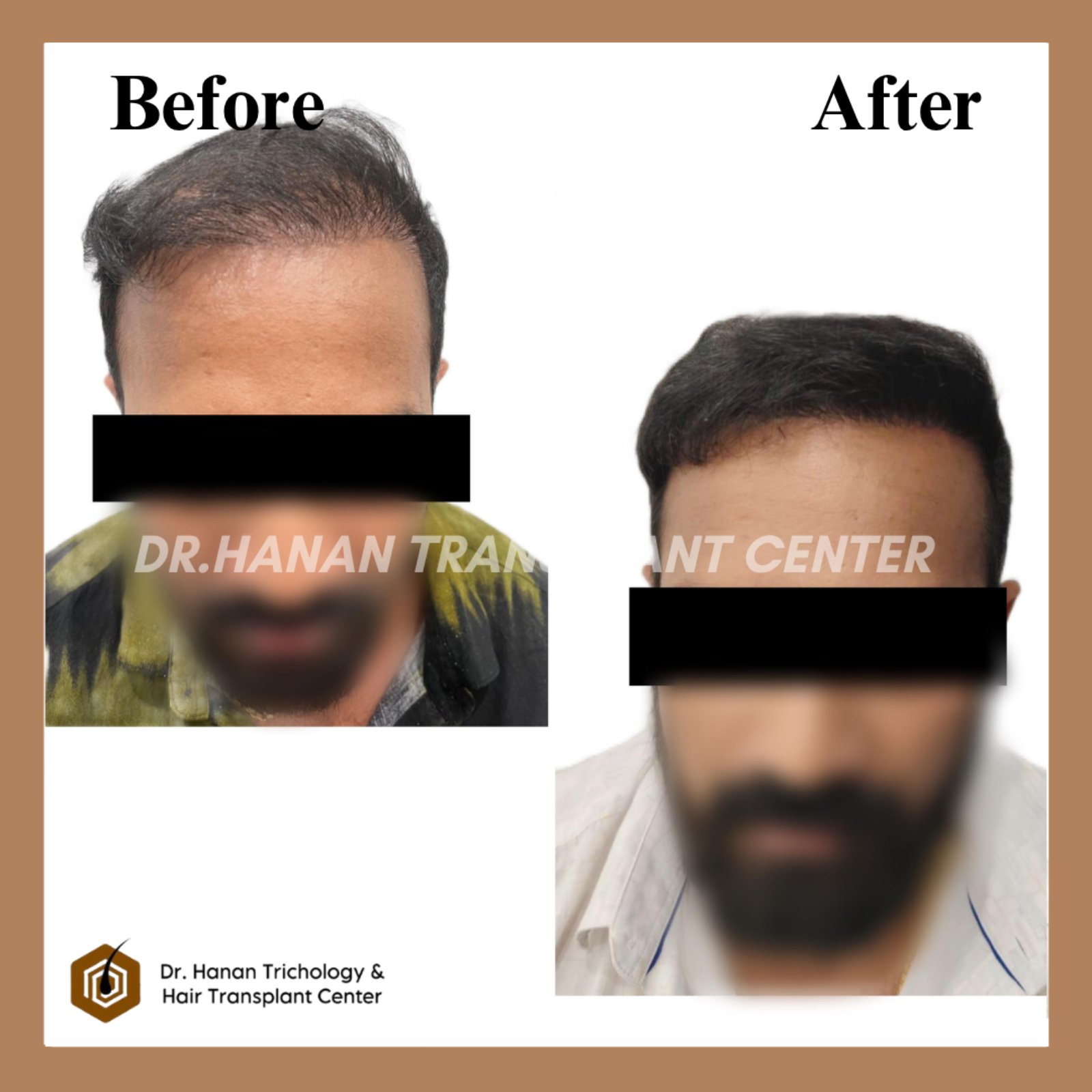 Hair Transplant Side Effects Fertility