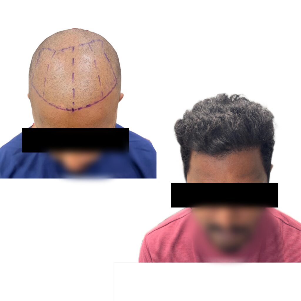 Stem Cell Hair Transplant in Chennai Stem Cell Hair Transplant in Chennai