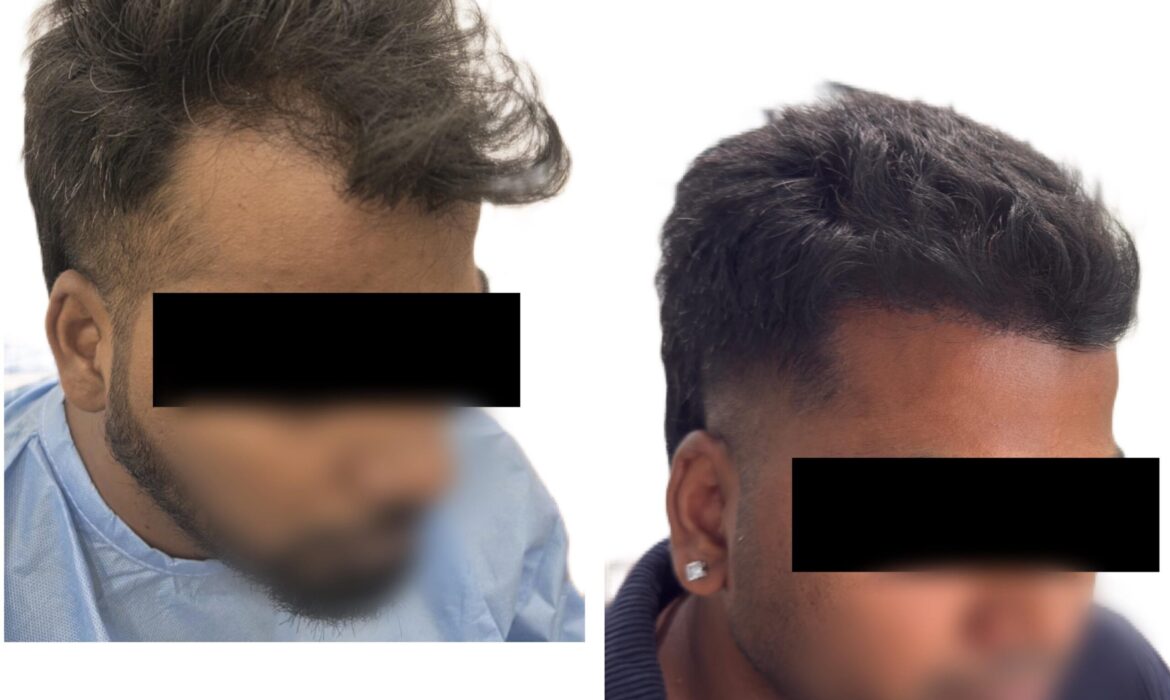 Hair Transplant Procedure Time