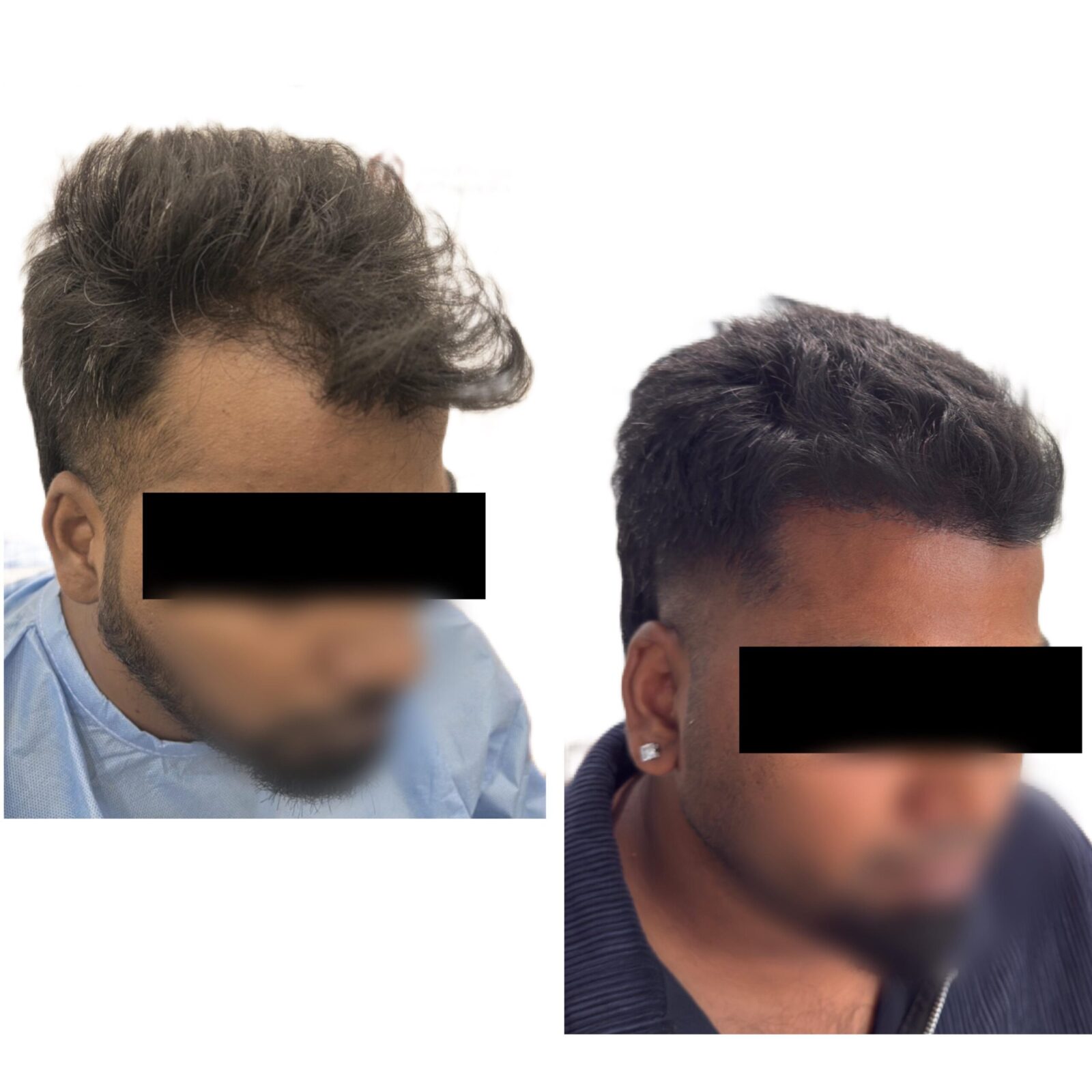 Hair Transplant Procedure Time