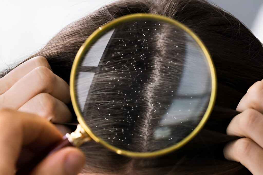 Best Treatments for Dandruff and Itchy Scalp