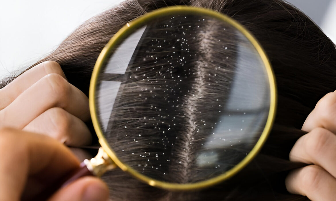 Best treatment for Dandruff