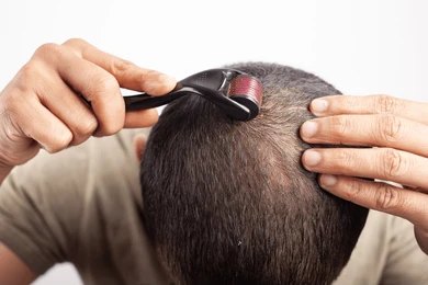 Dermaroller for hair growth Dermaroller for hair growth