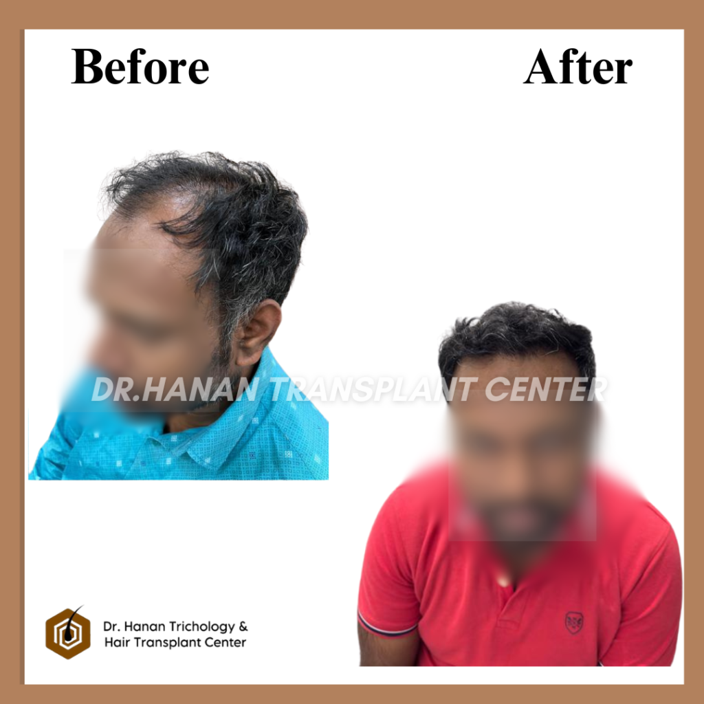 How Much Time for Hair Transplant to Grow How Much Time for Hair Transplant to Grow