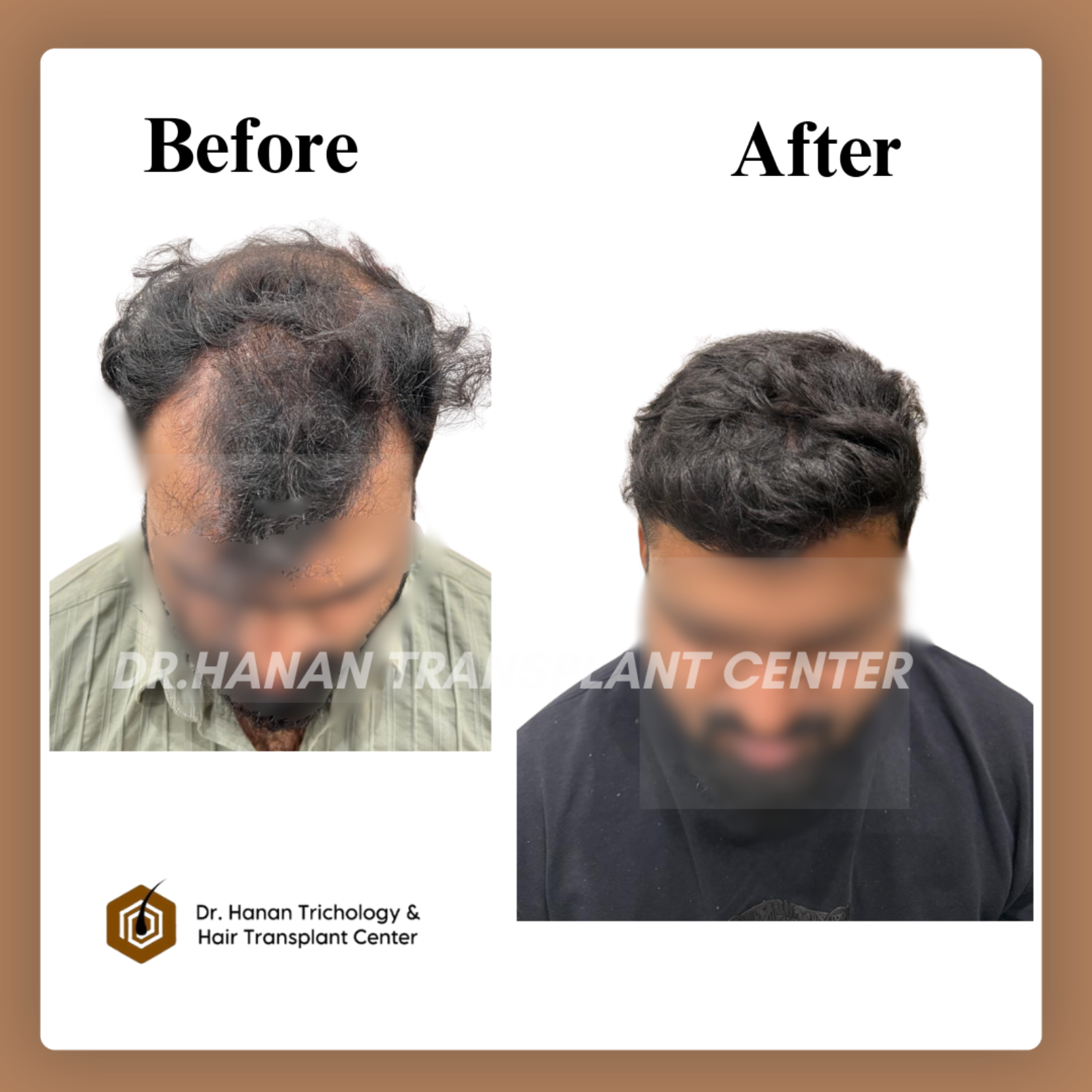 Top 5 Hair Transplant Clinic in Chennai