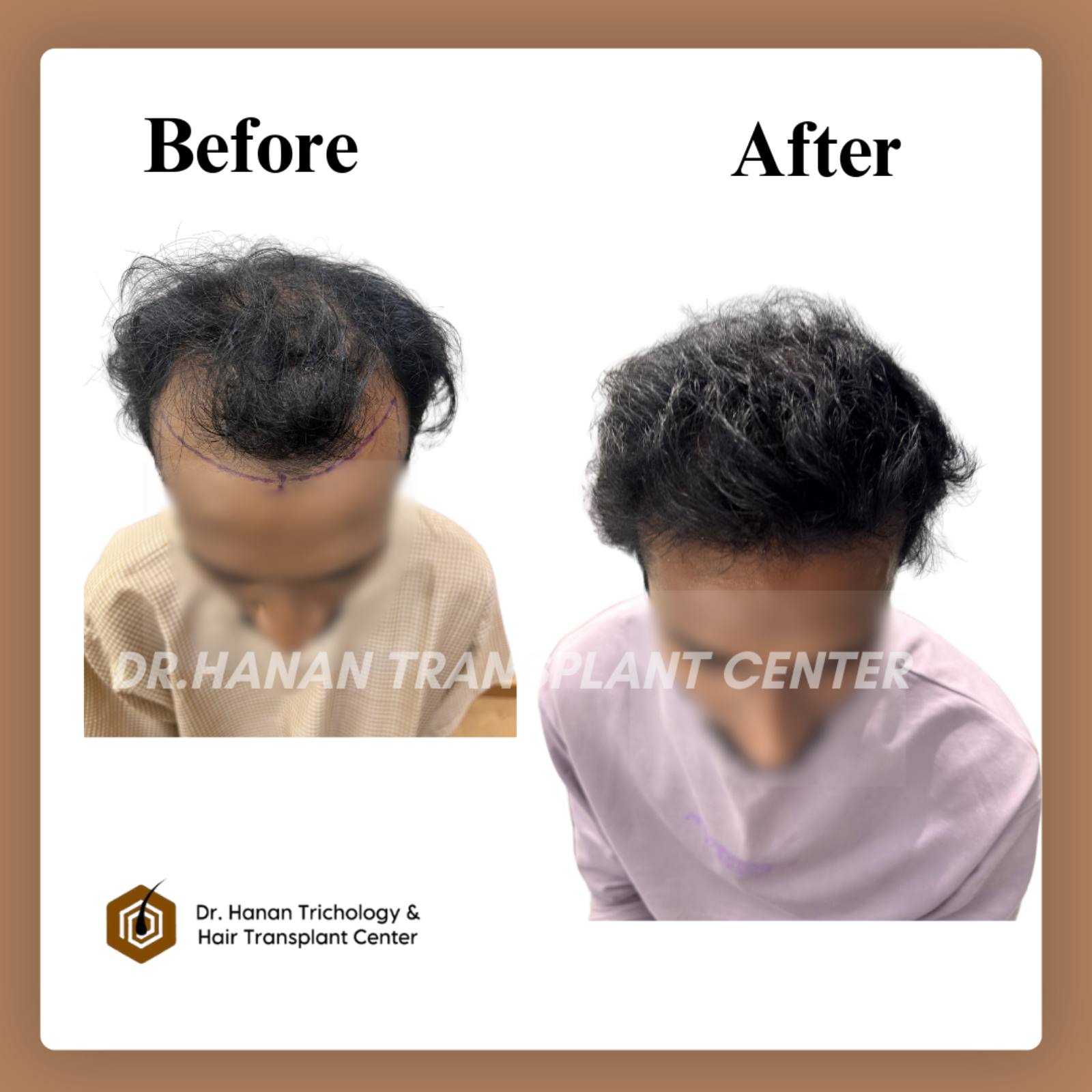 Long Hair Transplant in Chennai