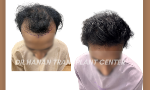 Long Hair Transplant in Chennai