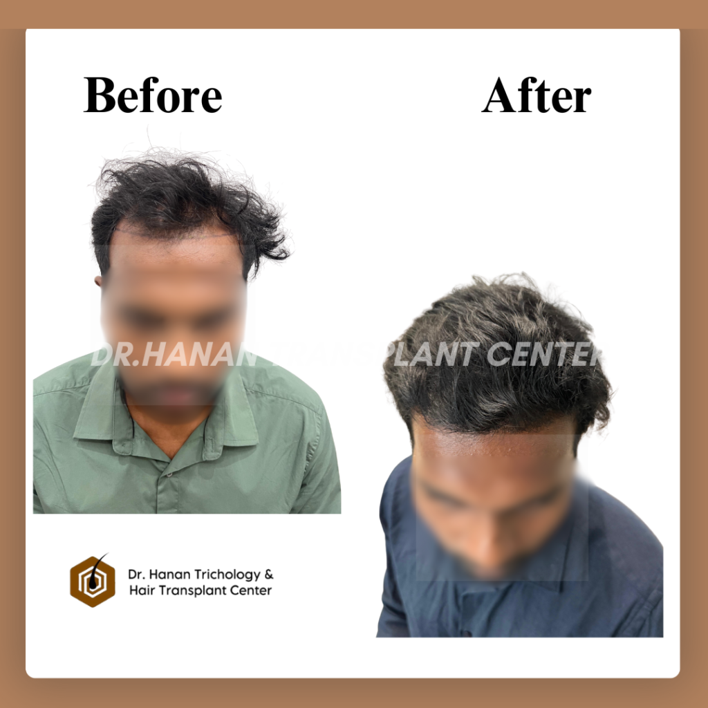 Best Age for Hair Transplant: Expert Guide for Natural and Long-Lasting Results