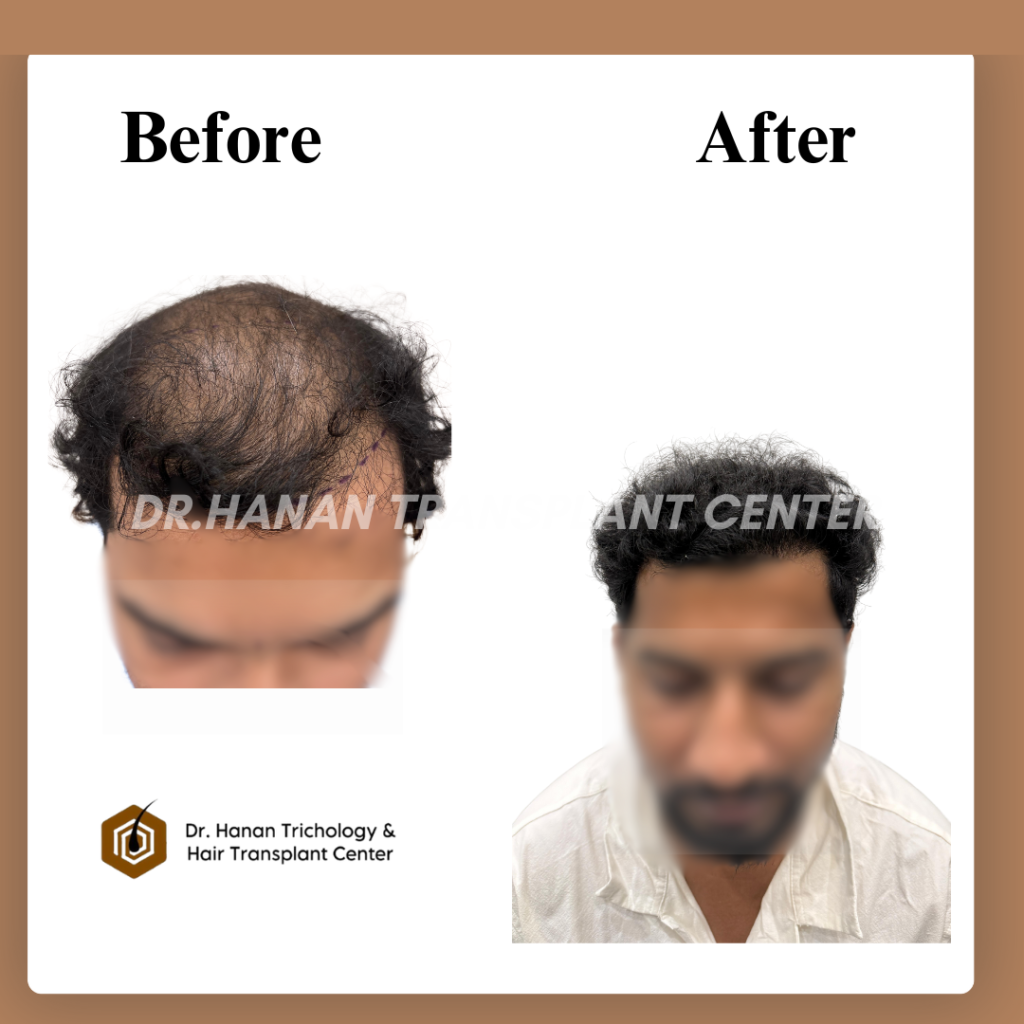Hair Transplant Results