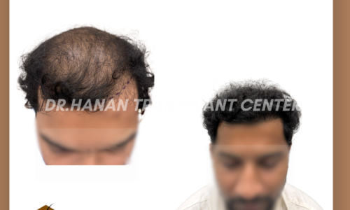 10 Days After Hair Transplant: What to Expect, Care Tips & Healing Timeline