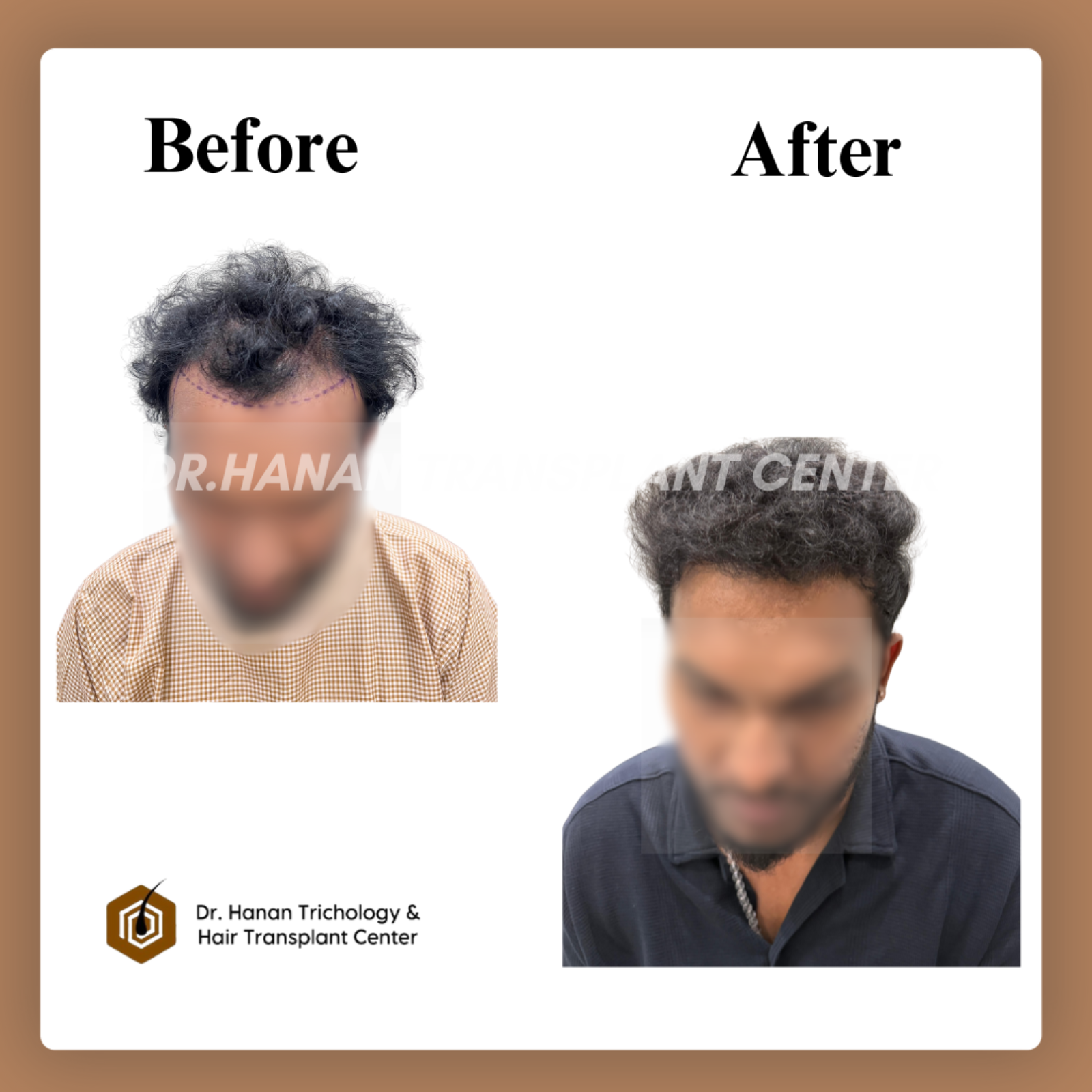 Best Age for Hair Transplant: Expert Advice from Dermatologists in Chennai