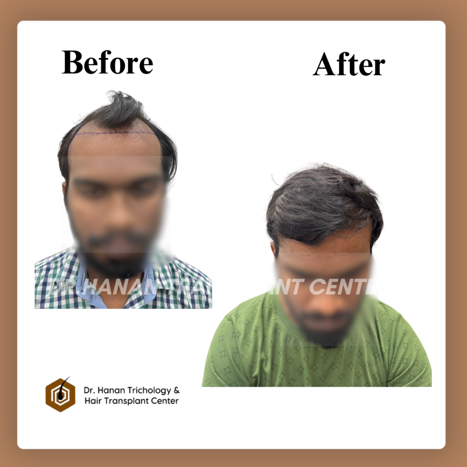 Micro FUE Hair Transplant in Chennai