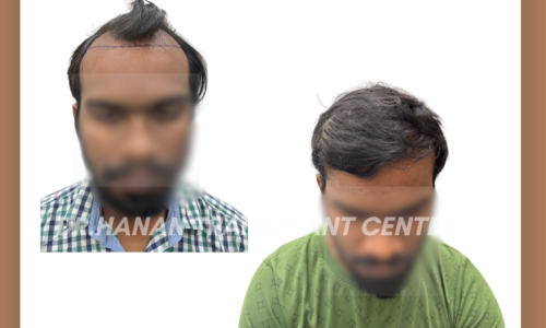 Micro FUE Hair Transplant in Chennai – Advanced, Scar-Free Hair Restoration at Dr. Hanan Dermatology Clinic