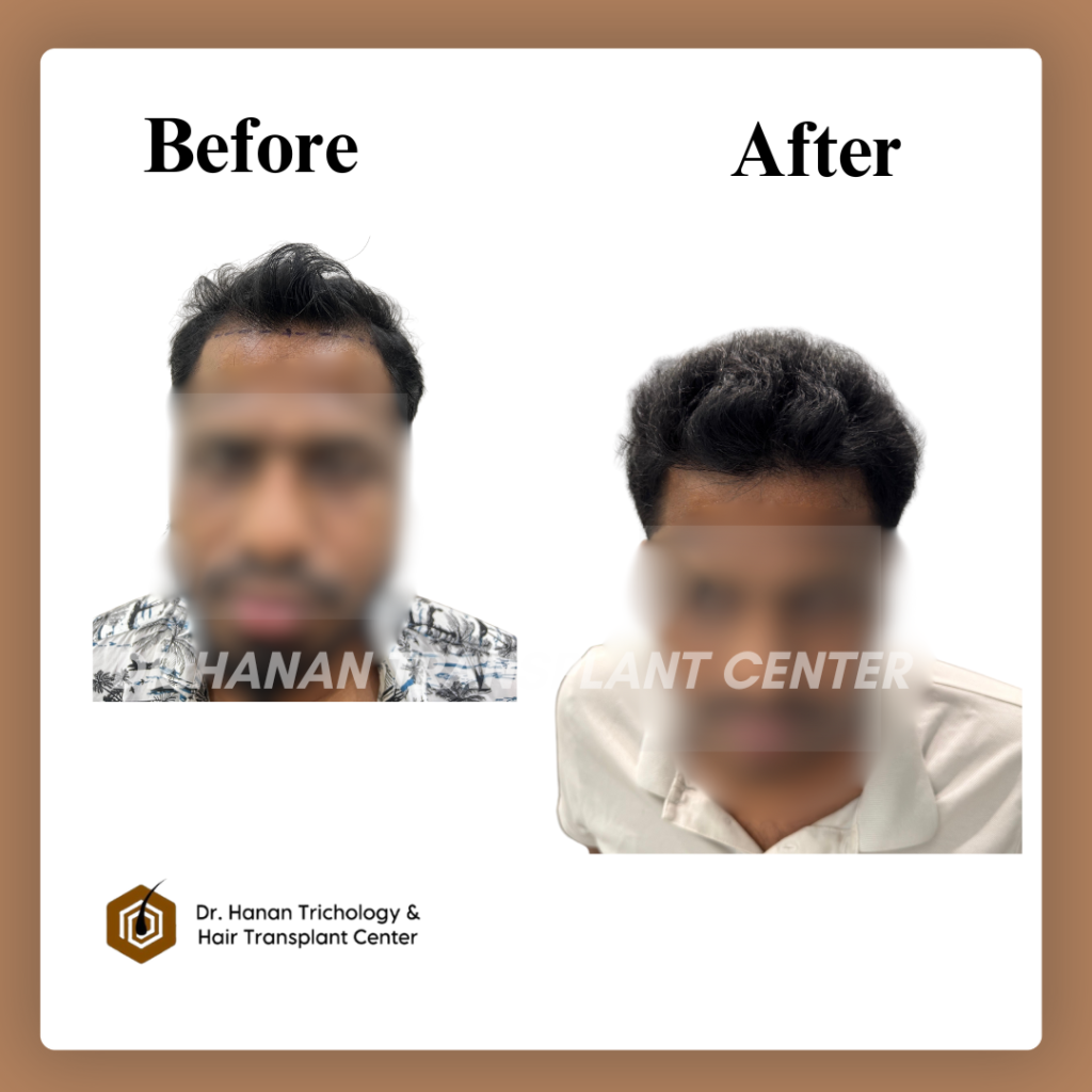 Is hair transplant safe