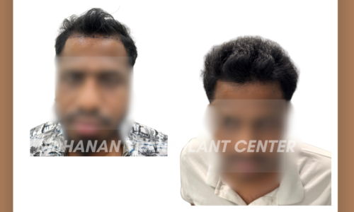 Is Hair Transplant Safe? Expert Insights from Dr. Hanan Dermatology Speciality Clinic, Chennai