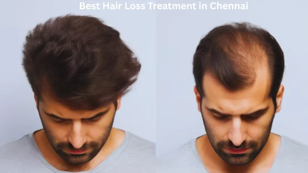 Best Hair Loss Treatment in Chennai Best Hair Loss Treatment in Chennai