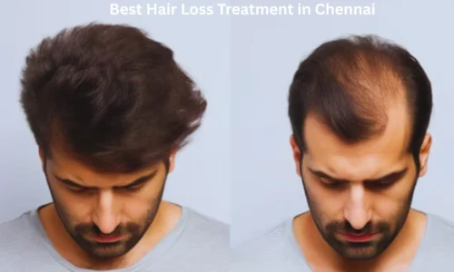 Best Hair Loss Treatment in Chennai – Expert Solutions by Dr. Hanan Dermatology Speciality Clinic