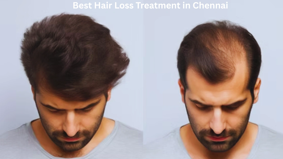 Best Hair Loss Treatment in Chennai