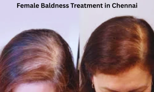 Female Baldness Treatment in Chennai: Price, Options & Expert Care