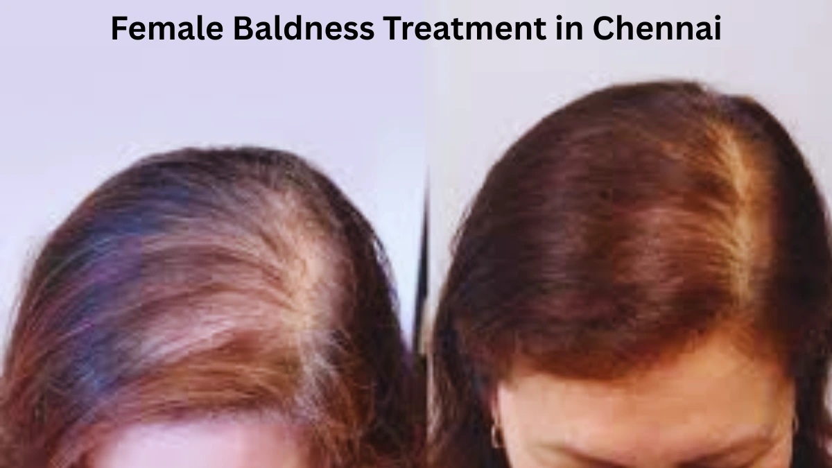 Female Baldness Treatment in Chennai