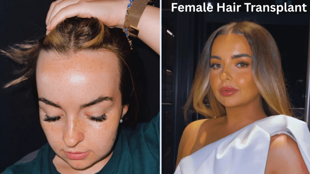 Female Hair Transplant