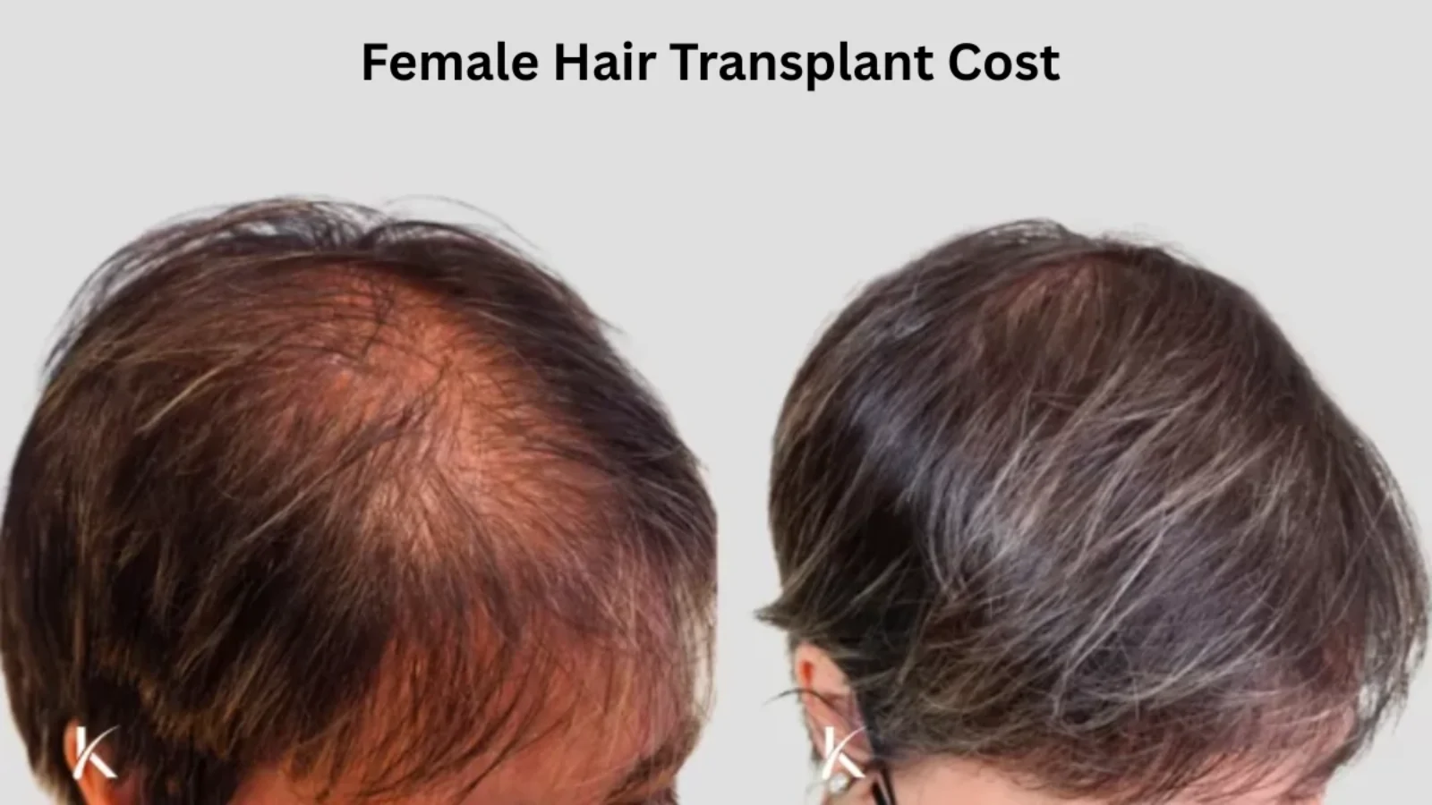 Female Hair Transplant Cost