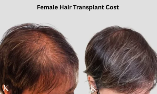 Female Hair Transplant Before and After – Real Results, Recovery & What to Expect