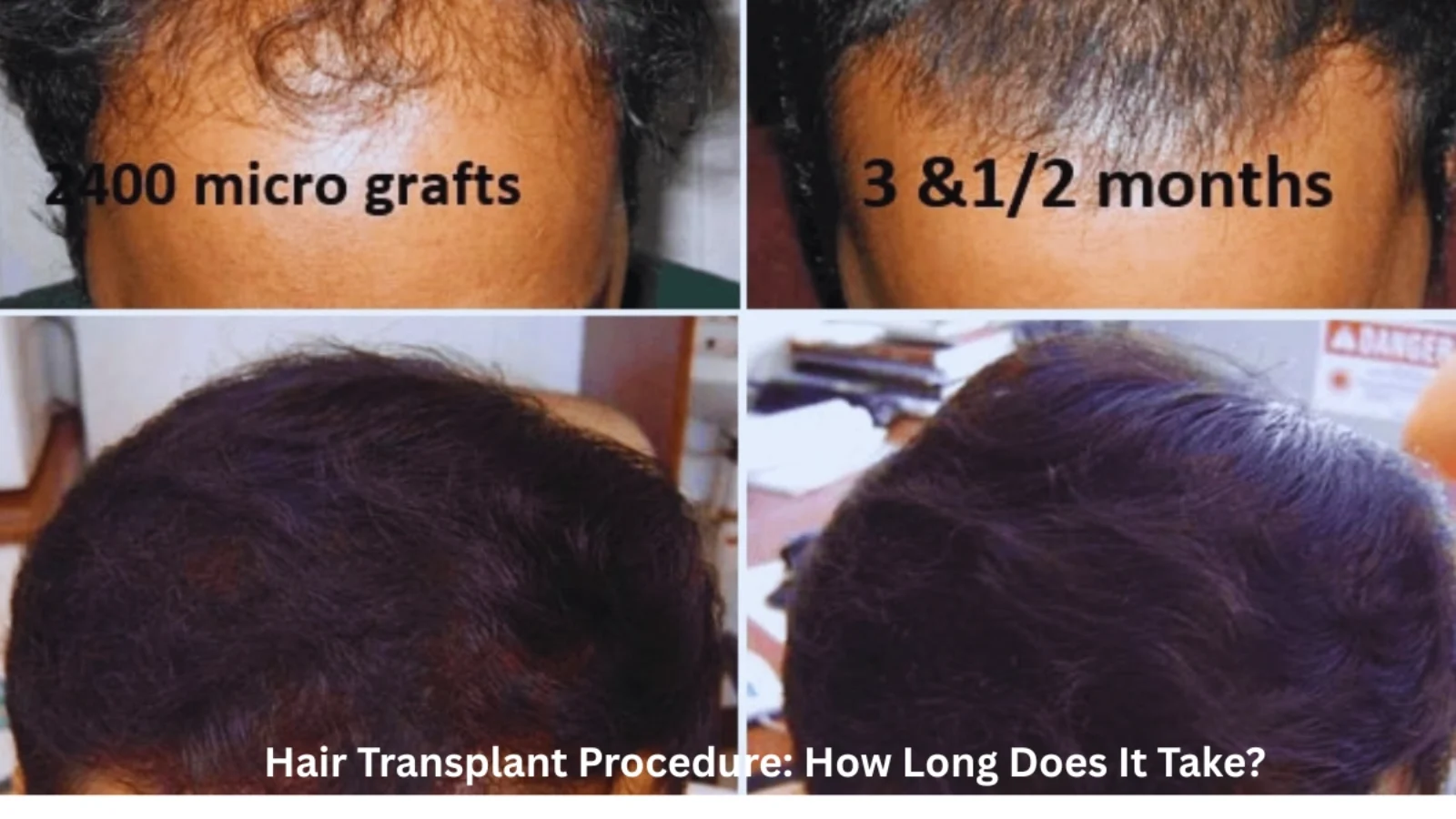 Hair Transplant Procedure: How Long Does It Take?