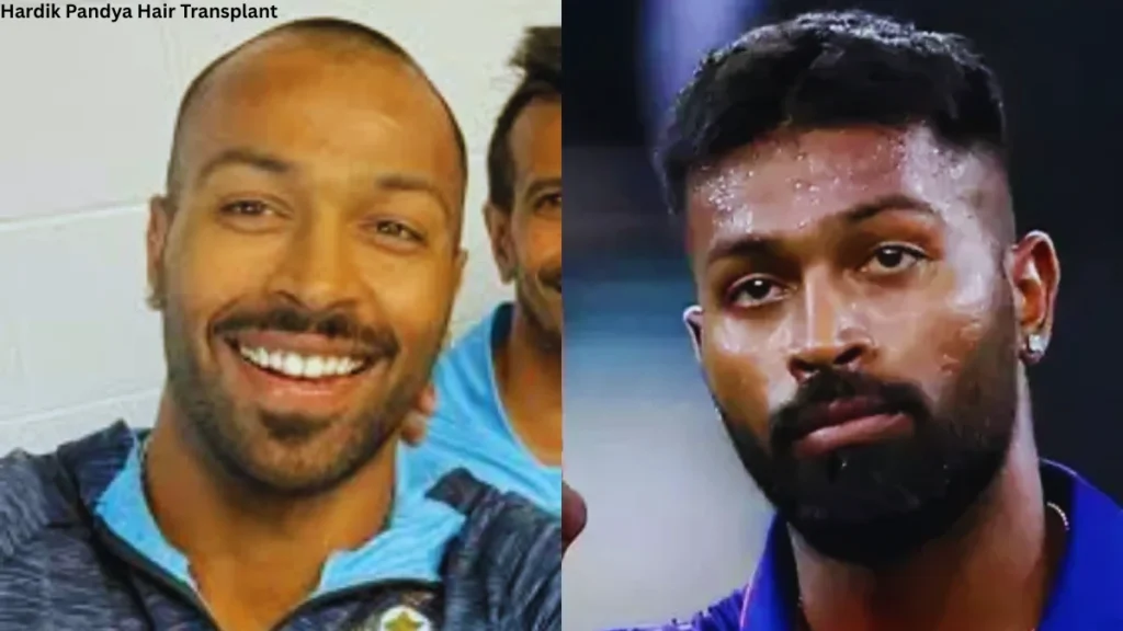 Hardik Pandya Hair Transplant Hardik Pandya Hair Transplant