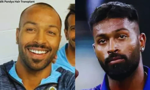 Hardik Pandya Hair Transplant – Insights and Inspiration