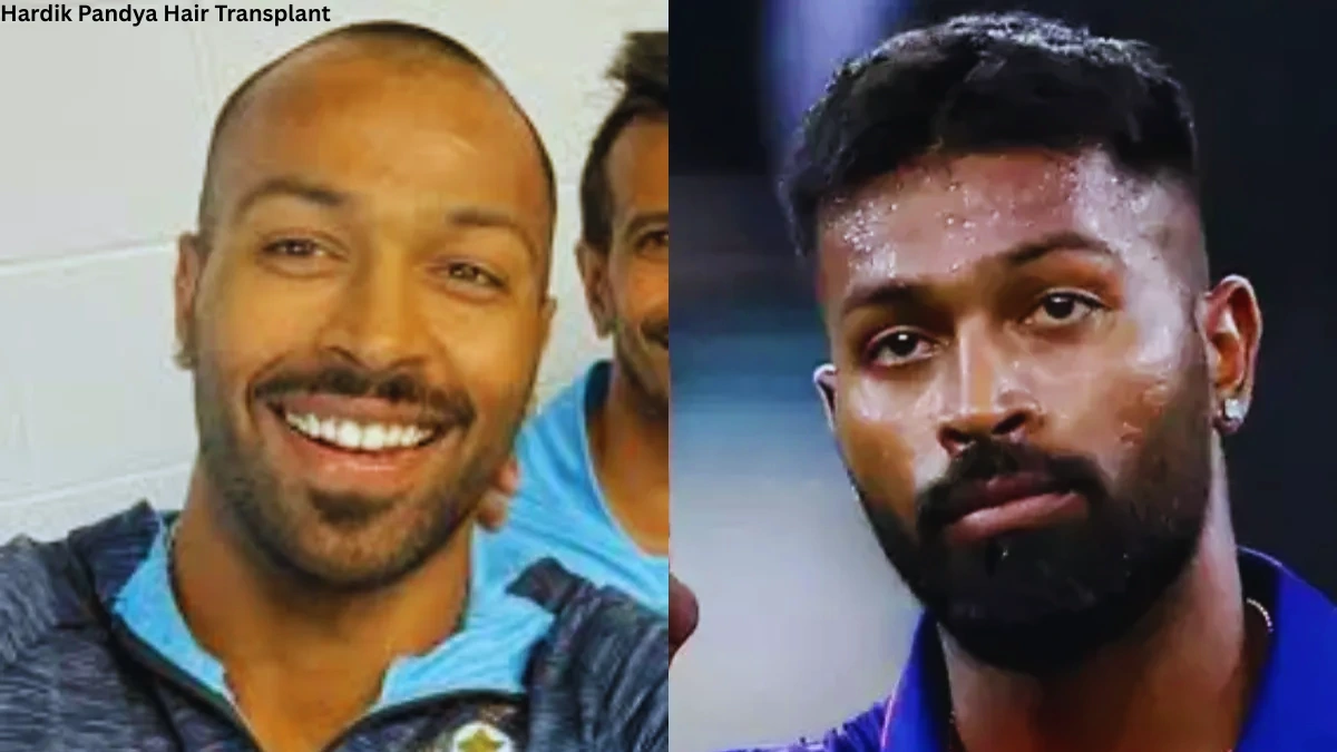 Hardik Pandya Hair Transplant