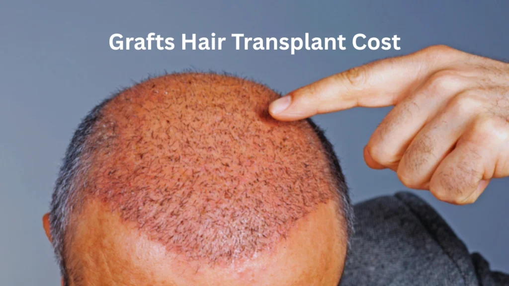 Grafts Hair Transplant Cost