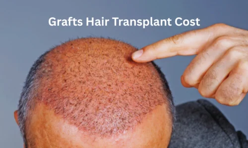 Grafts Hair Transplant Cost – Dr. Hanan Dermatology Speciality Clinic, Chennai
