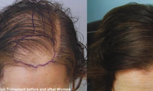 Hair Transplant Before and After Women – Dr. Hanan Dermatology Speciality Clinic, Chennai